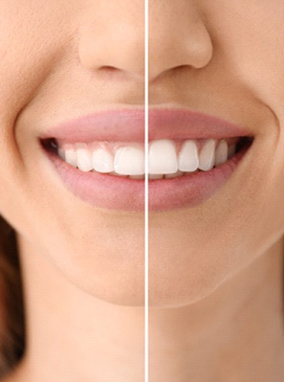 A side-by-side image of a person who underwent gummy smile correction in Houston