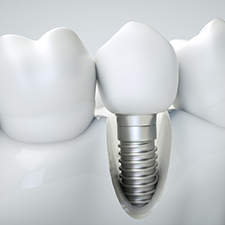 A digital image of a single dental implant and all its parts in Houston