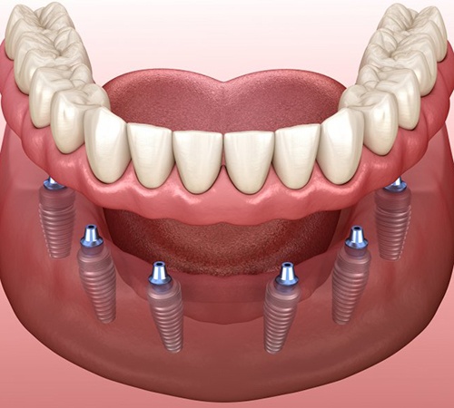implant denture supported by six dental implants 