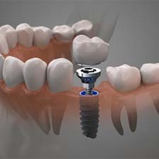 Diagram showing components of dental implants in Houston