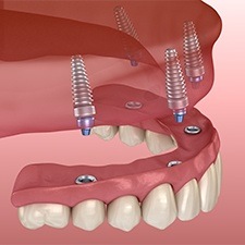 Animated All-on-4 denture placement